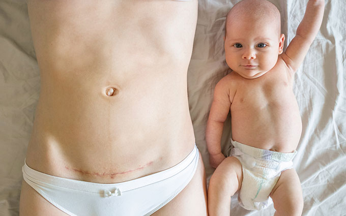 Mother with a c-section scar lying next to her baby