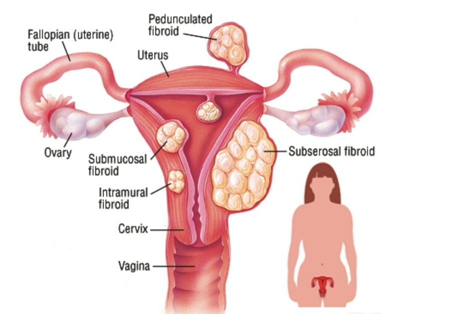 diagram of uterus with submucosal, intramural, subserosal, and pedunculated fibroids