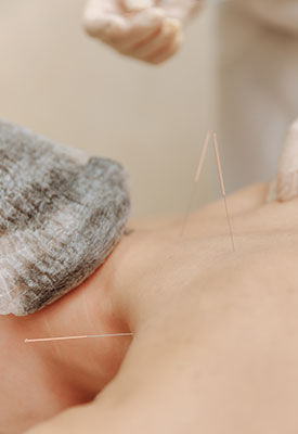 Dysmenorrhoea acupuncture