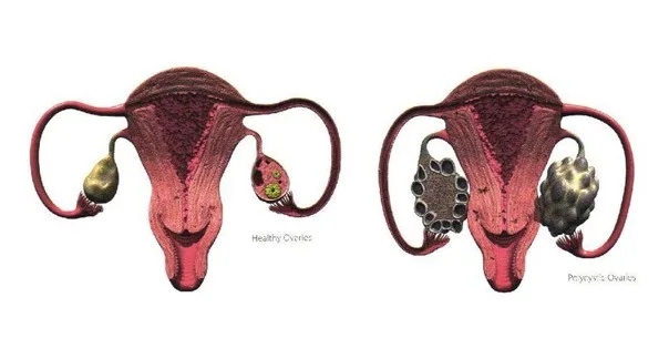 PCOS Specialist Melbourne
