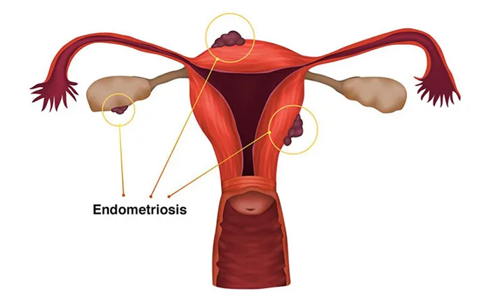 endometriosis graphic endometriosis graphic